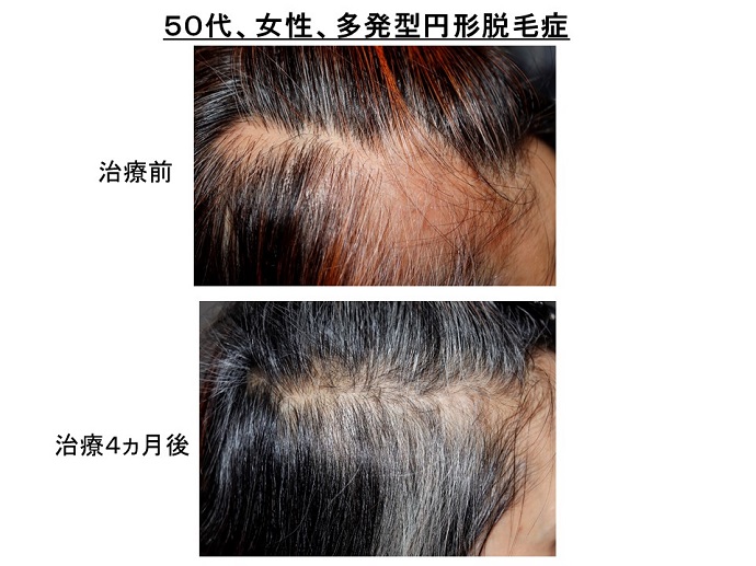 円形脱毛症　病院